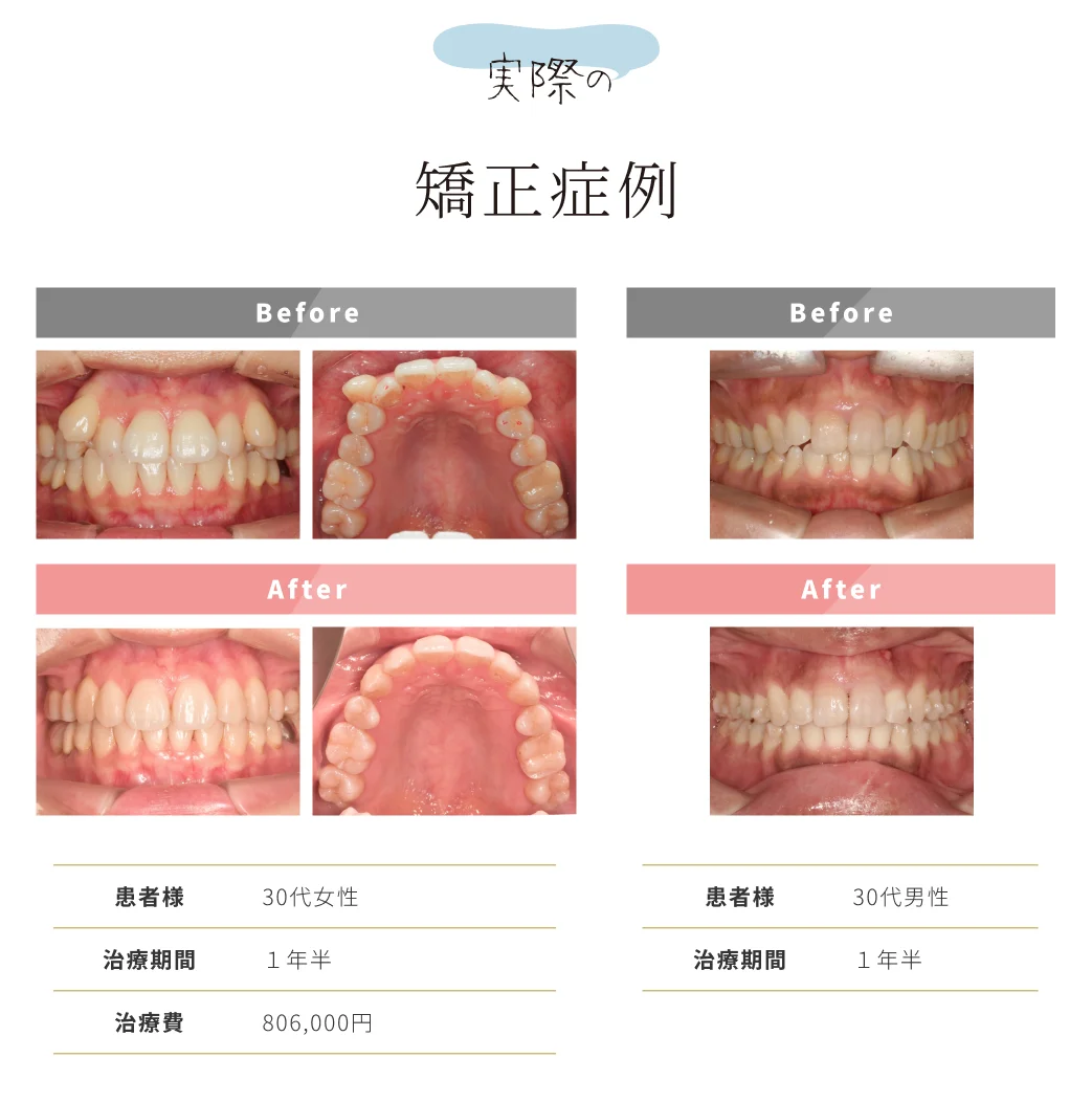 マウスピース矯正症例
